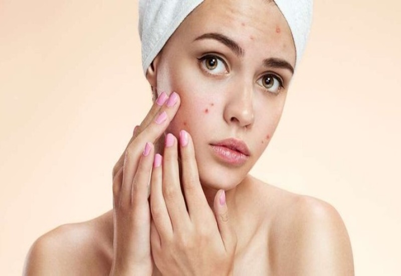 Mụn trứng cá là dấu hiệu của mất cân bằng nội tiết tố nữ 