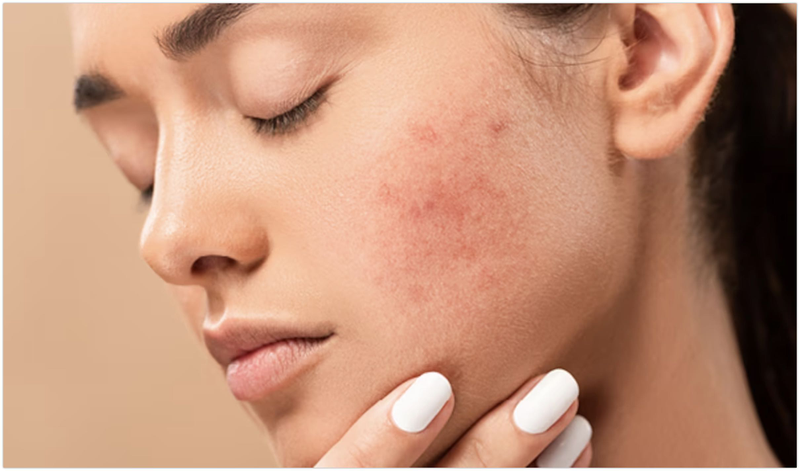 Khi trị mụn bằng bột đậu đỏ cần lưu ý các hiện tượng da bị kích ứng và ngưng sử dụng để xử lý kịp thời