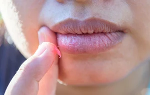 Liệu trị thâm môi bằng vitamin C có thực sự hiệu quả?